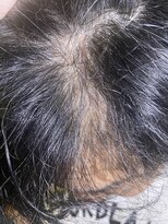 グローリープラス(glory+)&nbsp;経過観察