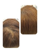 ユーフォルムギンザ(y-Forme Ginza)&nbsp;話題のトキカタ♪頭頂部編