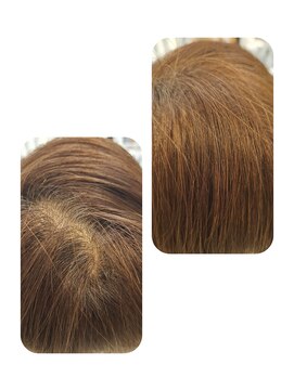 ユーフォルムギンザ(y-Forme Ginza) 話題のトキカタ♪頭頂部編