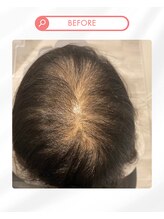 ヒト幹細胞を使用したトリートメント１[都賀駅]