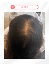 ヒト幹細胞を使用したトリートメント２[都賀駅]