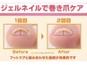【巻き爪矯正♪】kanonn指名限定　巻き爪フット1本～￥4980