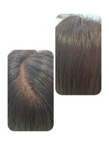 ユーフォルムギンザ(y-Forme Ginza) 話題のトキカタ♪頭頂部編