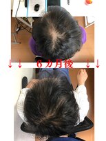 エルアスク 頭皮ケアプログラム