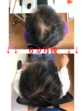 エルアスク 育毛促進ケア