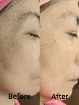 グラスヒビキ レディースシェービングエステ:悩み【くすみ、小さなシミ】