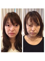 アドール(ADOR)&nbsp;韓国式小顔コルギ