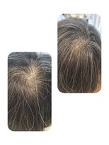 ユーフォルムギンザ(y-Forme Ginza) 話題のトキカタ♪頭頂部編