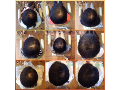 髪の毛促進ヘッドスパも好評です（約６ヶ月後）左上から右下です