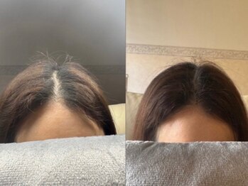 増毛エクステ専門店 頭皮ケアサロン fleurの写真/つむじや後頭部の悩みの方必見!自然な増毛エクステで、自信を取り戻すお手伝いをいたします。