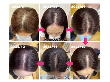 【ヒト幹細胞ケアでボリューム・ツヤのエイジング対策】