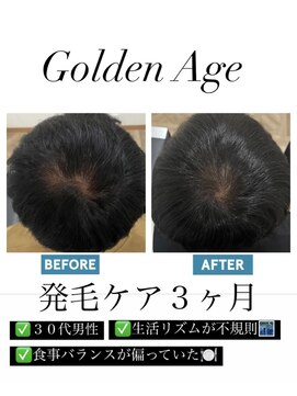 ゴールデンエイジ(Golden Age) 【発　毛　ケ　ア　３ヶ月】Before＆After