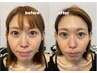 “エクソソーム”の美肌★フェイスケア￥11,000⇒￥１０，０００