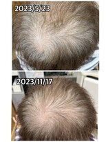 エミ(EMI)&nbsp;育毛促進