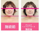 銀座ねむり姫 GINZA east店&nbsp;ほほ、あごがすっきり！目も大きくなりました