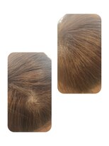 ユーフォルムギンザ(y-Forme Ginza)&nbsp;話題のトキカタ♪頭頂部編