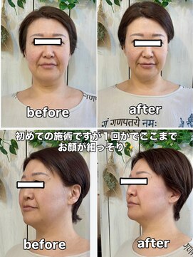 ラシック(La shic) お顔引き上げテラボ-ラ-!!#テラボ-ラ-#エクソソ-ム