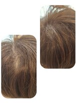 ユーフォルムギンザ(y-Forme Ginza)&nbsp;話題のトキカタ♪頭頂部編