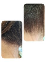 ユーフォルムギンザ(y-Forme Ginza)&nbsp;話題のトキカタ♪襟足編