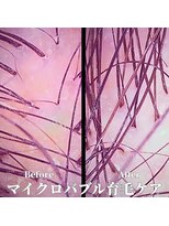 プレゴ 清澄白河平野店(Prego)&nbsp;マイクロバブル育毛促進ケアBefore&After