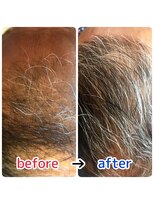 ブルーフィン シセロ(Blue Fin cicero) 頭皮改善!育毛促進ケア