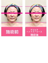 銀座ねむり姫 GINZA east店&nbsp;ほほ、あごがすっきり！目も大きくなりました