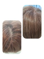 ユーフォルムギンザ(y-Forme Ginza)&nbsp;話題のトキカタ♪頭頂部編