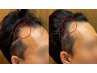 【髪の薄い所を今すぐ改善したい方必見！】3Dドットペインティング技法