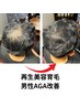 【育毛促進・男性専用】100%純度ヒト臍帯幹細胞上清液100%使用￥44000→￥27500