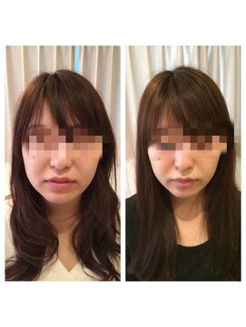 アドール(ADOR) 韓国式小顔コルギ