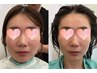 【小顔効果抜群!お顔パック付】デトックススパ＋保湿ケア ￥11,000→￥9,900