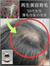 【再生育毛・女性専用】集中育毛改善５回コース