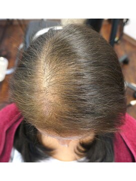 タイガ 上野御徒町(TAIGA) 【必見！！】(毛細りにお悩み)スキャルプケア５