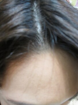 ヨシユキコンディショニング Before-つむじ補正