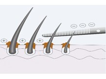毛根の皮脂除去
