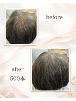 ビューティーアンドオン 西葛西 葛西(beauty.And On)&nbsp;頭頂部～後頭部全体に増毛エクステ