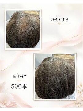 ビューティーアンドオン 西葛西 葛西(beauty.And On) 頭頂部～後頭部全体に増毛エクステ