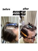 頭皮改善エステ(細毛トリートメント)