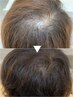 【高濃度幹細胞で圧倒的育毛促進効果】ヒト幹細胞100％＋髪質改善￥22000