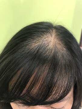 フォレスト(forest) 育毛促進　【施術前】