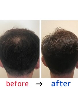 ブルーフィン シセロ(Blue Fin cicero) 頭皮改善！育毛促進ケア