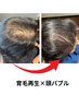 【育毛促進・女性専用】100%純度ヒト臍帯幹細胞上清液100%使用￥44000→￥27500