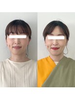 レトア(Letoa)&nbsp;ビフォーアフター