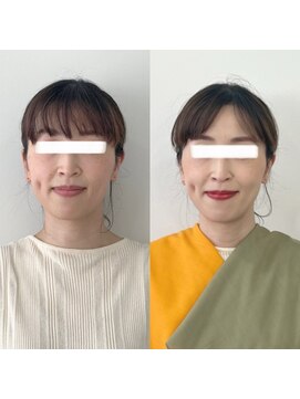 レトア(Letoa) ビフォーアフター