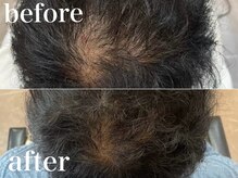 ヘア サルーン(HAIR SALOON)の雰囲気（【育毛促進プログラム】高濃度ヒト幹細胞培養液でボリューム改善）