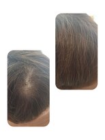 ユーフォルムギンザ(y-Forme Ginza) 話題のトキカタ♪頭頂部編