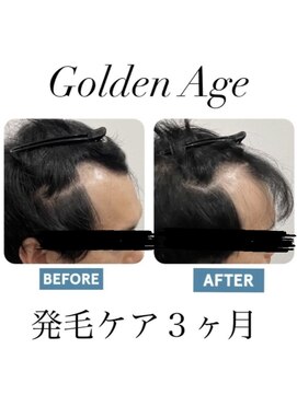 ゴールデンエイジ(Golden Age) 【発　毛　ケ ア 3ヶ月】Before＆After