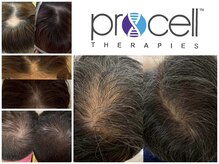 シール(Syl)の雰囲気(話題の育毛プログラムプロセルセラピーズ)