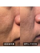 サーカス 南風原店(circus)&nbsp;幹細胞フェイシャルケア