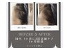 【11月限定/育毛促進】効果実感率NO1！２回分施術クーポン
